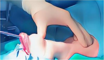 Vestibular approach for thyroid surgery: a comprehensive review